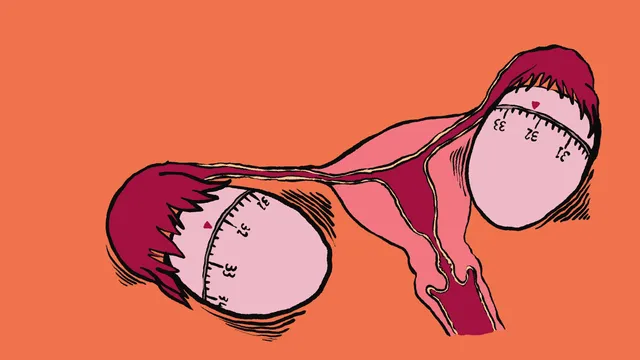 Illustratie van een baarmoeder waarbij de eierstokken eruit zien als eierwekkers